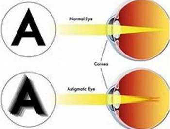 Gráfico de astigmatismo