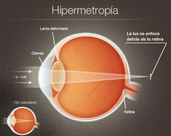 Gráfico de la hipermetropia