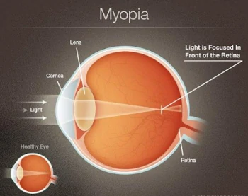 Gráfico de la miopia